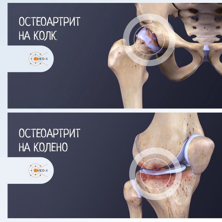 Остеоартрит на колено и колк - Med-X